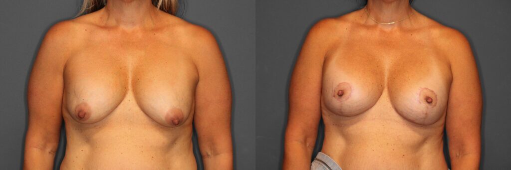 Breast Revision Before and After photo by Dr. Abigail Rodriguez in Houston, TX