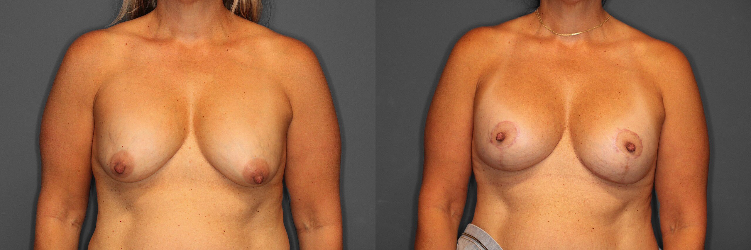 Breast Revision Before and After photo by Dr. Abigail Rodriguez in Houston, TX