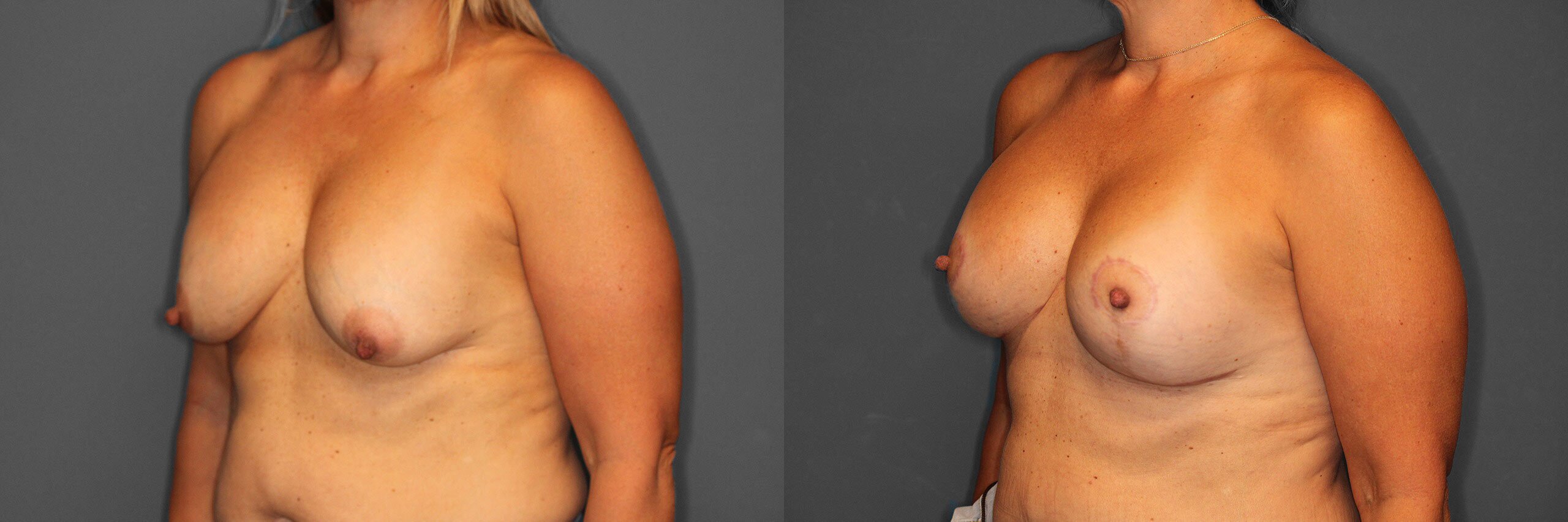 Breast Revision Before and After photo by Dr. Abigail Rodriguez in Houston, TX