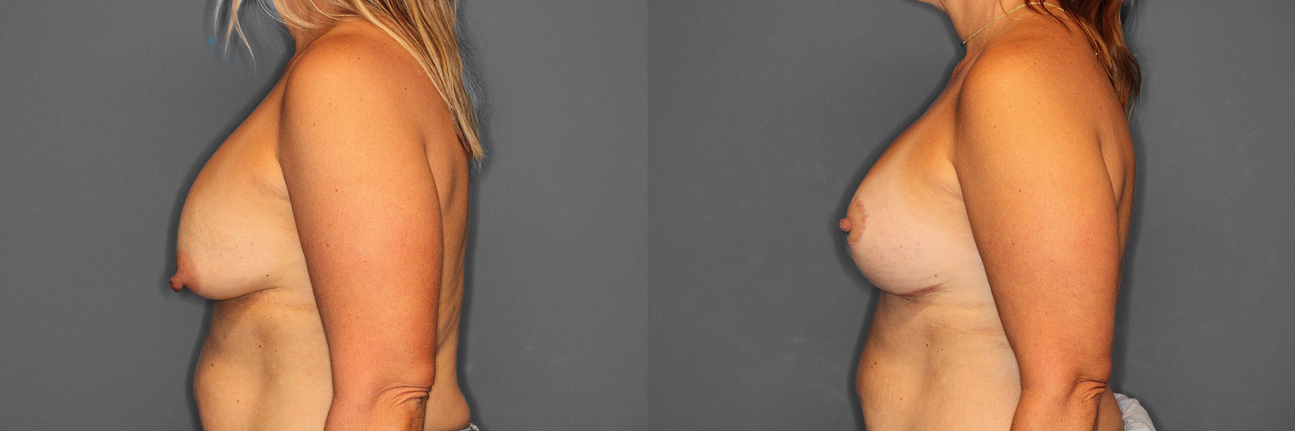 Breast Revision Before and After photo by Dr. Abigail Rodriguez in Houston, TX