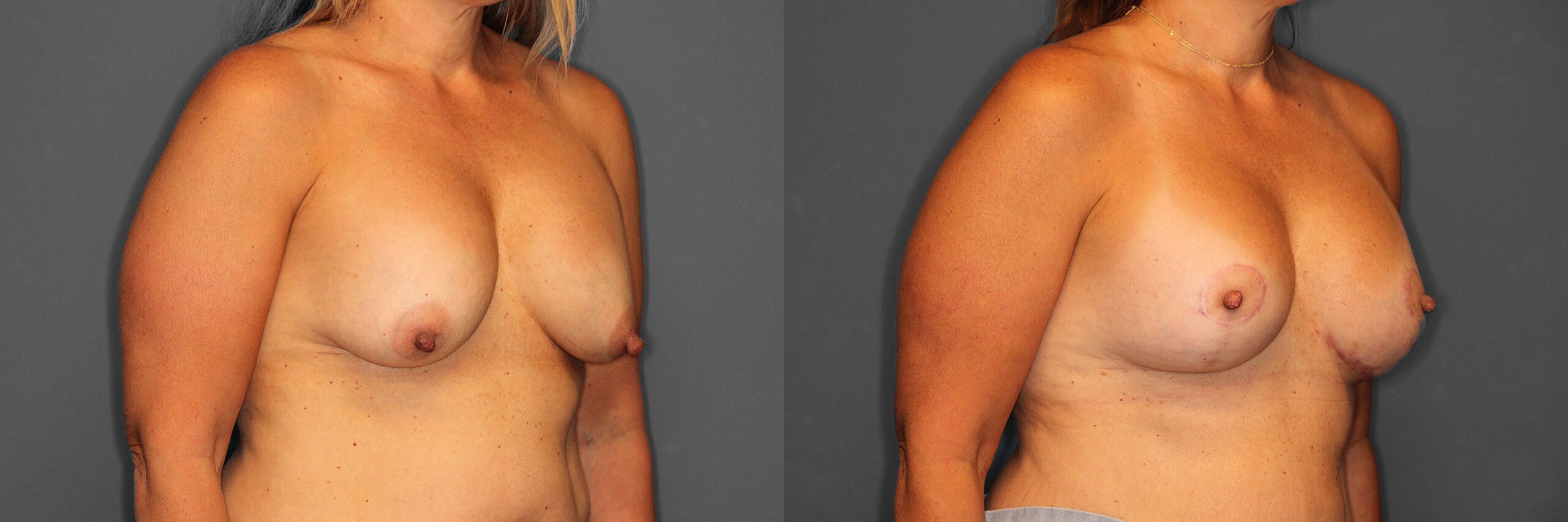 Breast Revision Before and After photo by Dr. Abigail Rodriguez in Houston, TX