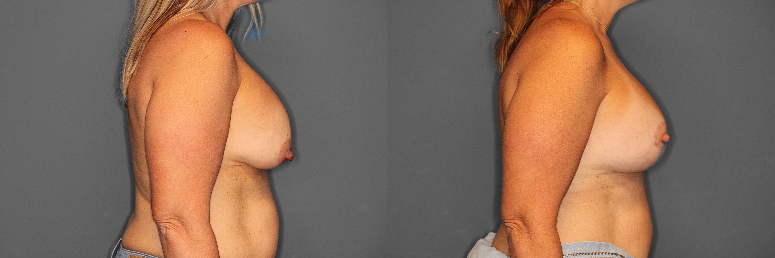 Breast Revision Before and After photo by Dr. Abigail Rodriguez in Houston, TX
