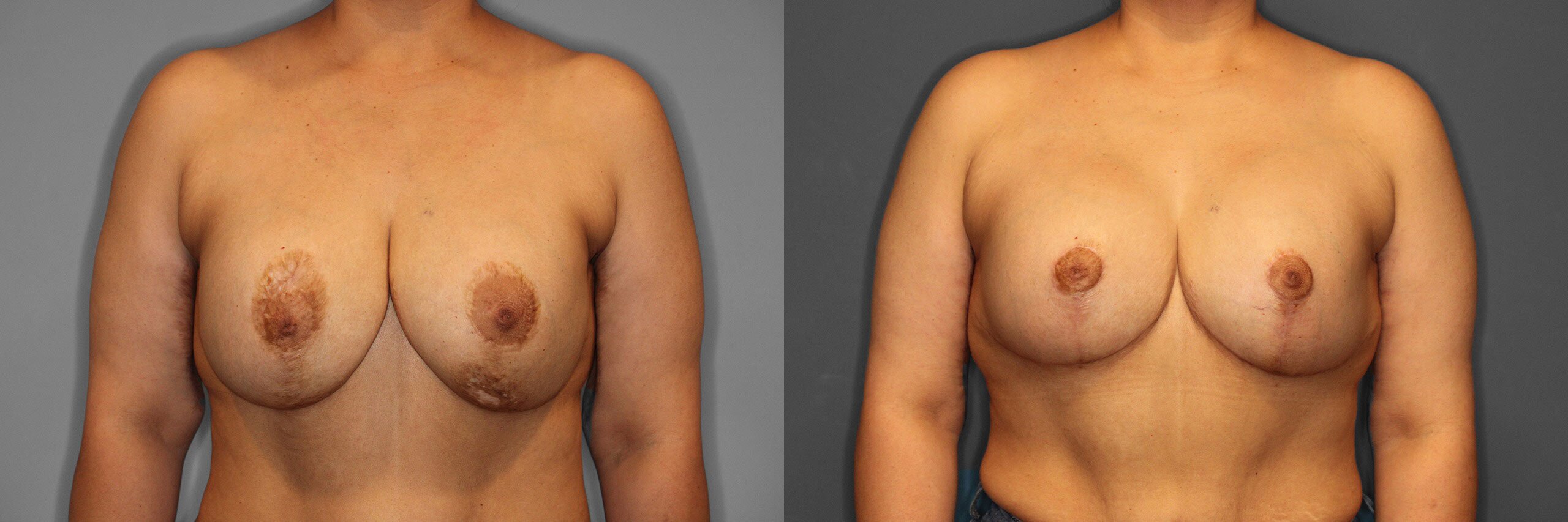Breast Revision Before and After photo by Dr. Abigail Rodriguez in Houston, TX