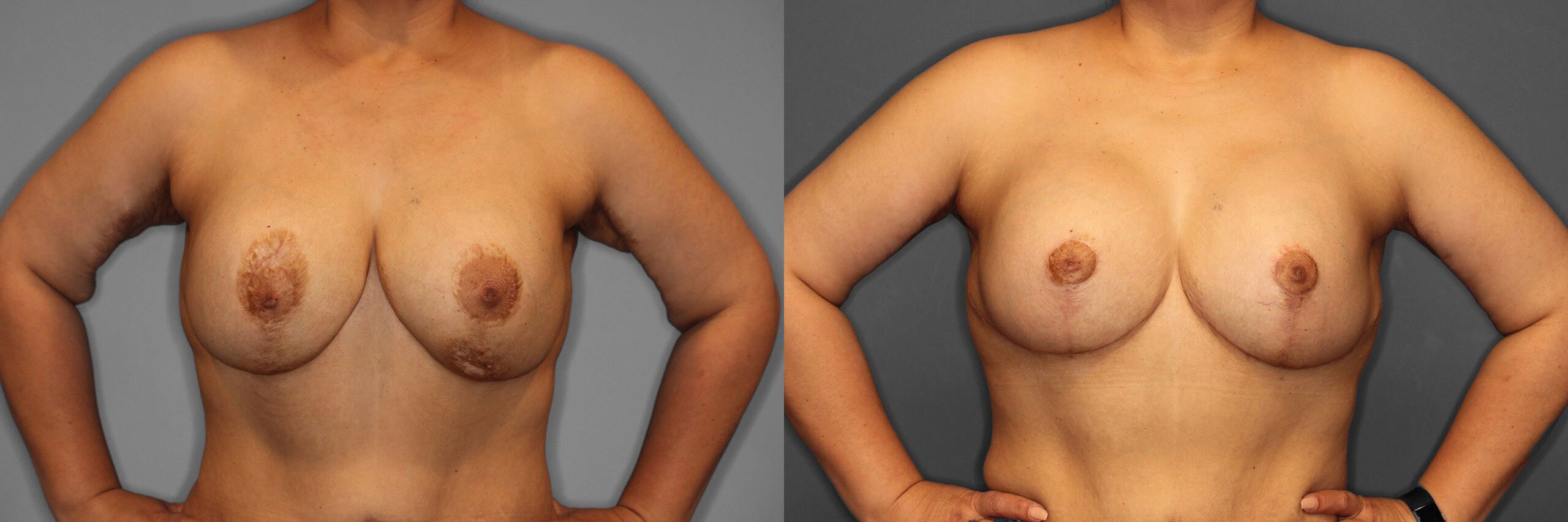 Breast Revision Before and After photo by Dr. Abigail Rodriguez in Houston, TX