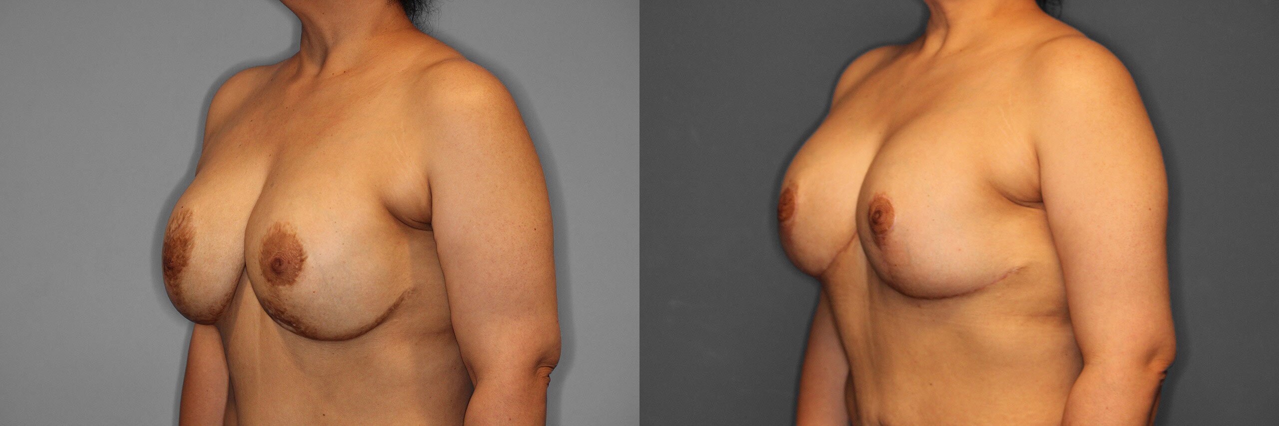 Breast Revision Before and After photo by Dr. Abigail Rodriguez in Houston, TX
