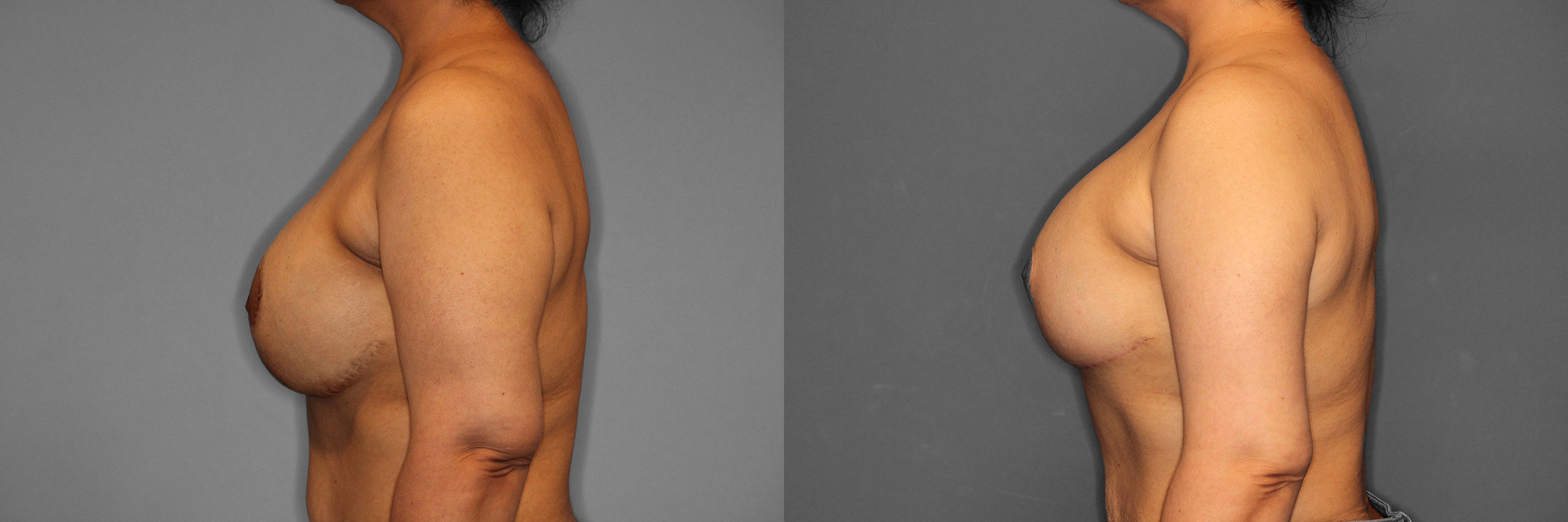 Breast Revision Before and After photo by Dr. Abigail Rodriguez in Houston, TX