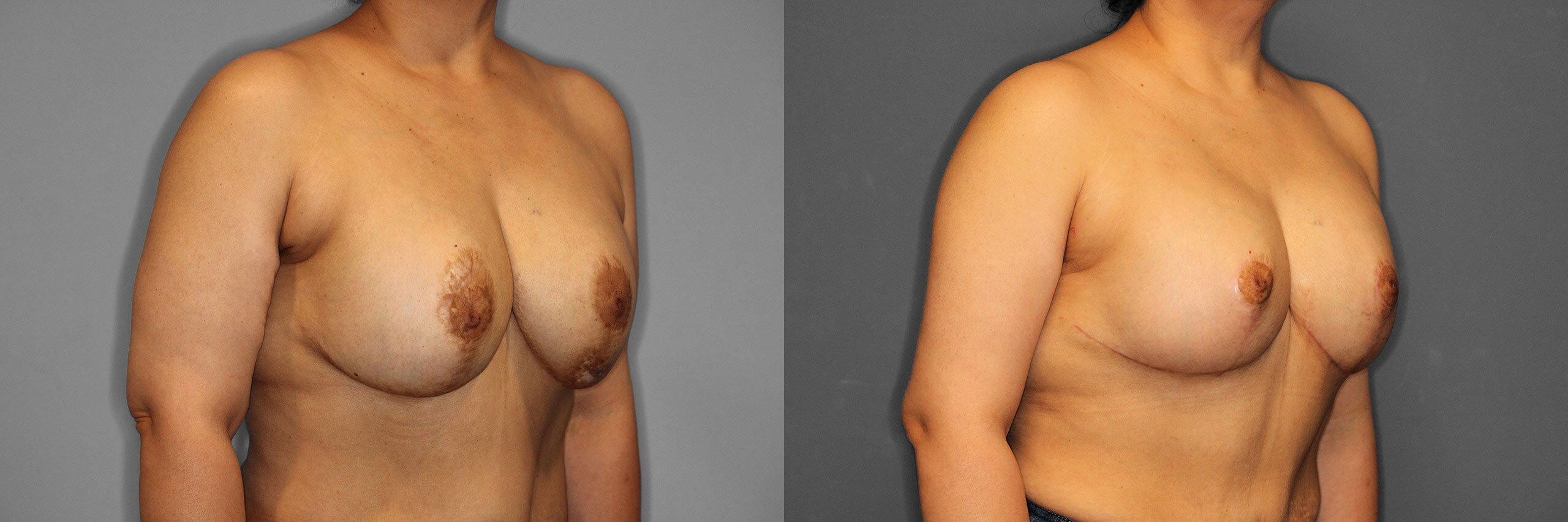 Breast Revision Before and After photo by Dr. Abigail Rodriguez in Houston, TX