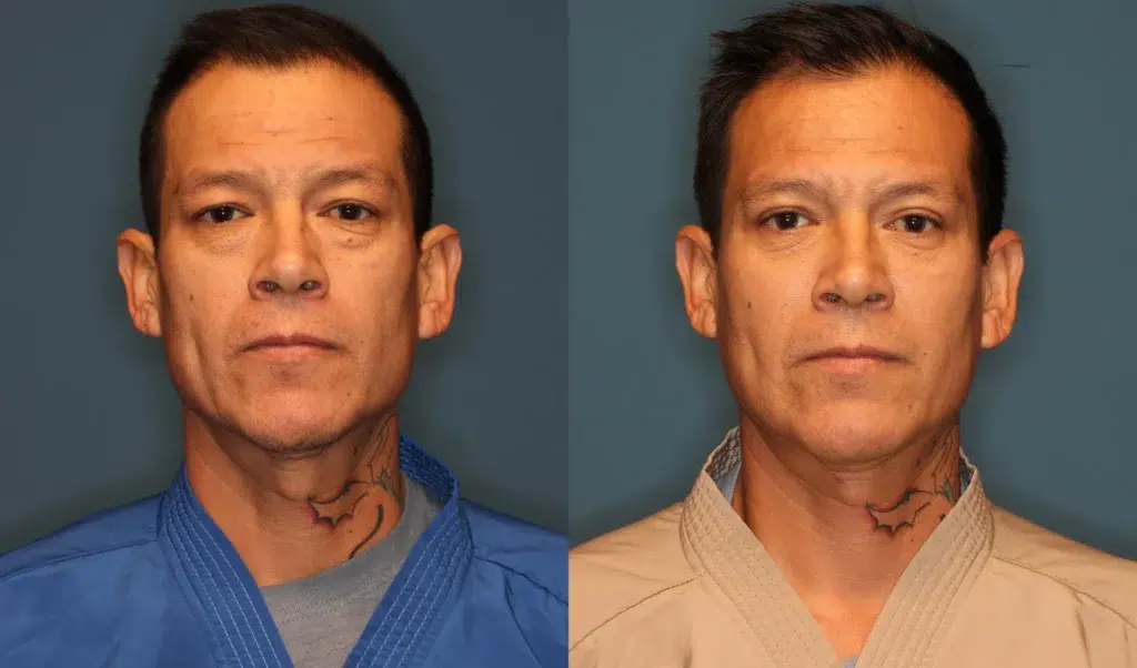 Eyelid Lift Before and After photo by Dr. Abigail Rodriguez in Houston, TX