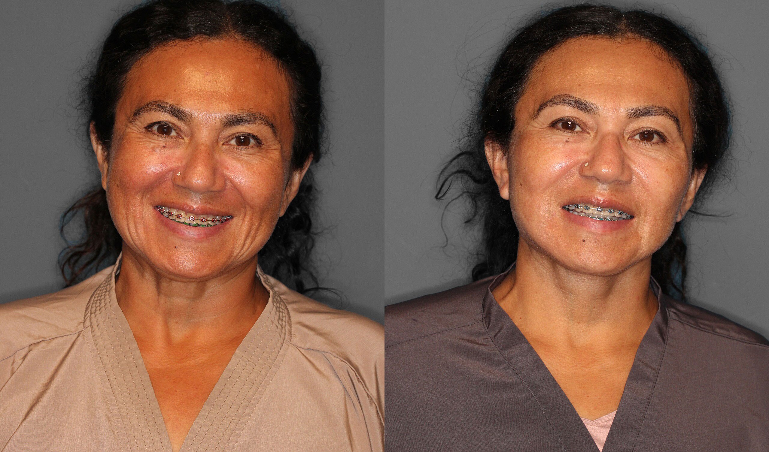 Face Neck Lift Before and After photo by Dr. Abigail Rodriguez in Houston, TX