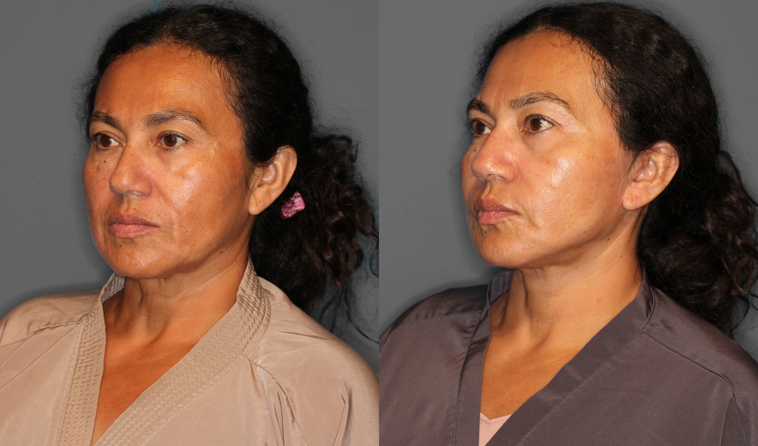 Face Neck Lift Before and After photo by Dr. Abigail Rodriguez in Houston, TX