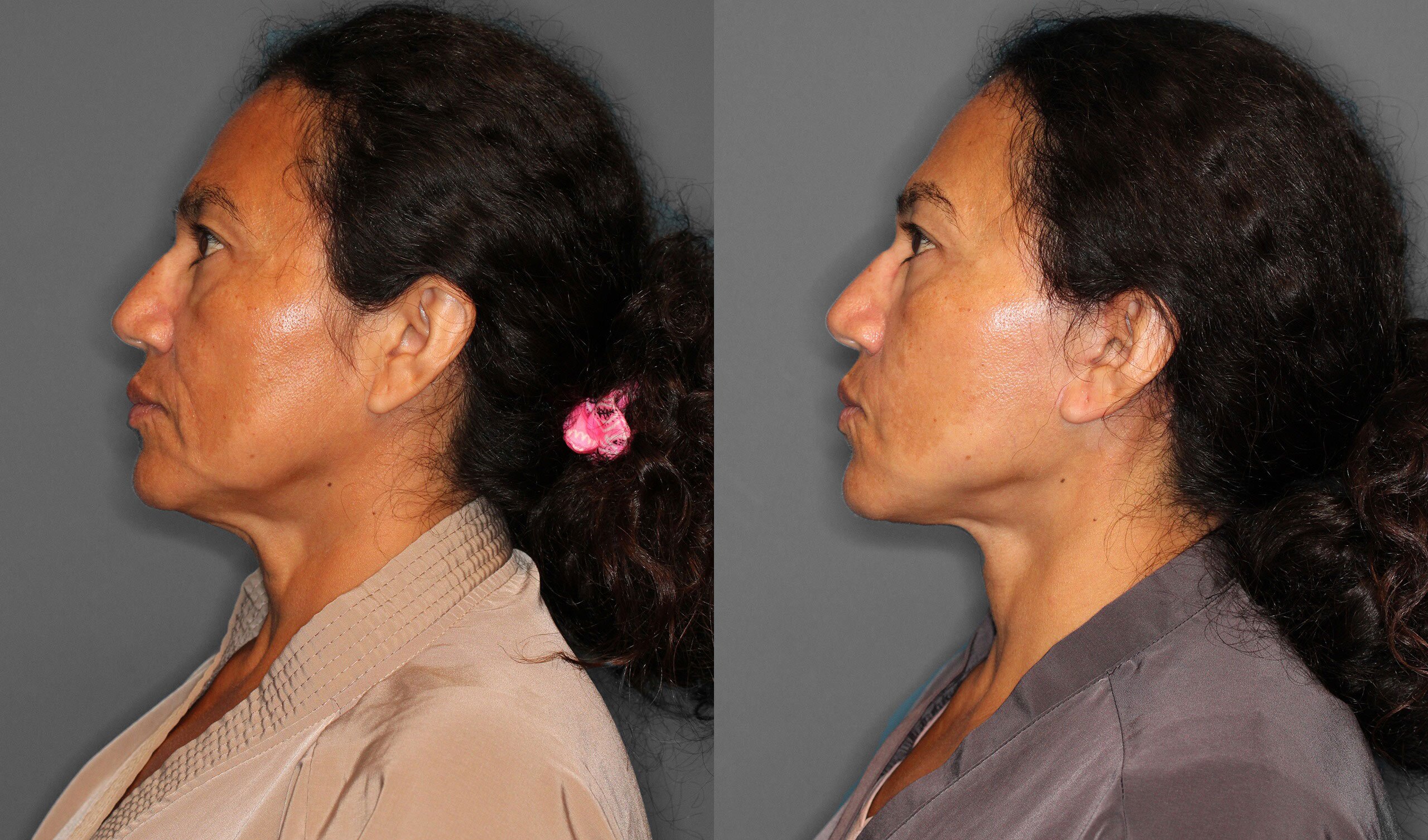 Face Neck Lift Before and After photo by Dr. Abigail Rodriguez in Houston, TX