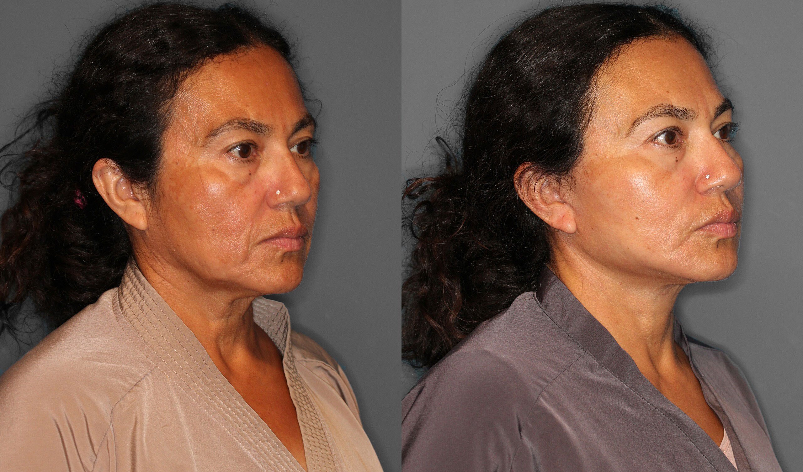 Face Neck Lift Before and After photo by Dr. Abigail Rodriguez in Houston, TX