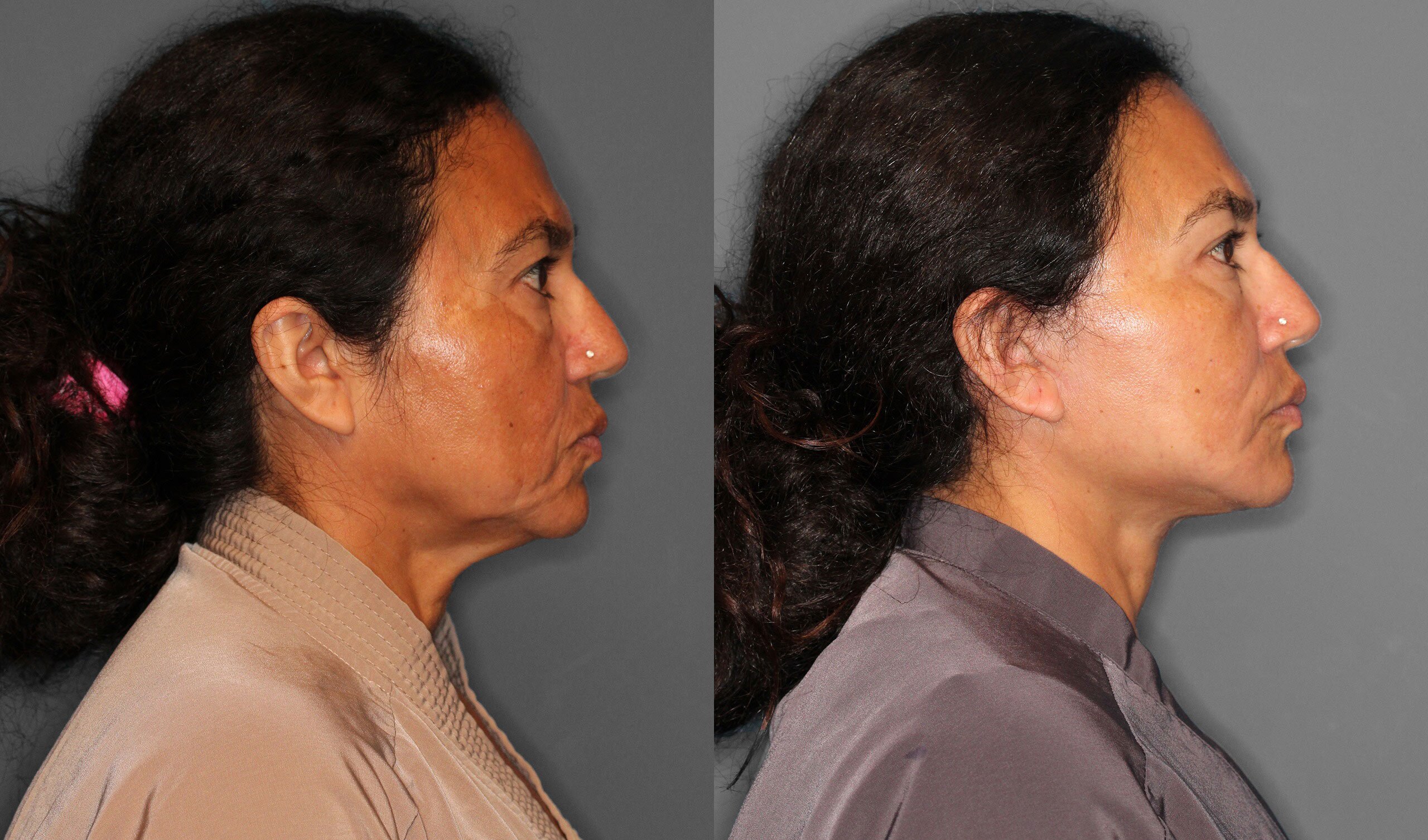 Face Neck Lift Before and After photo by Dr. Abigail Rodriguez in Houston, TX