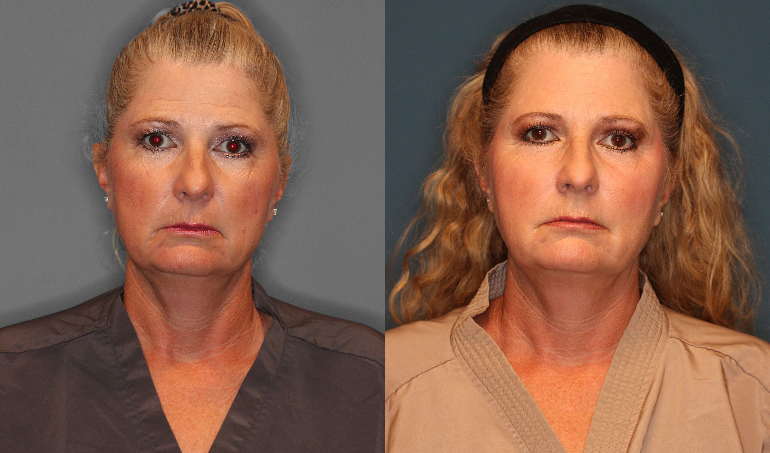 Facial Fat Grafting Before and After photo by Dr. Abigail Rodriguez in Houston, TX