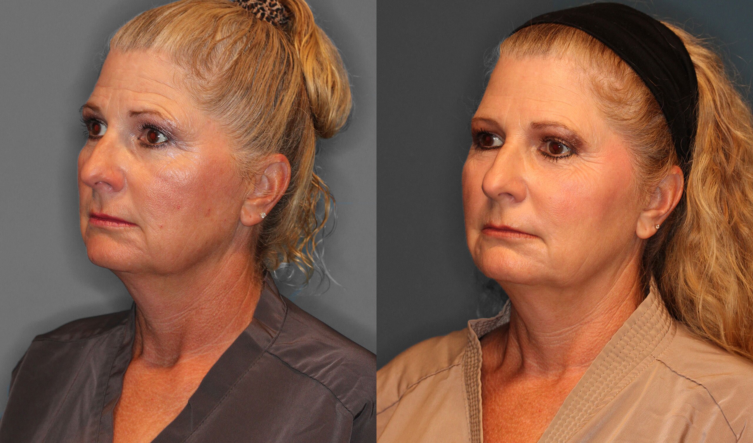 Facial Fat Grafting Before and After photo by Dr. Abigail Rodriguez in Houston, TX
