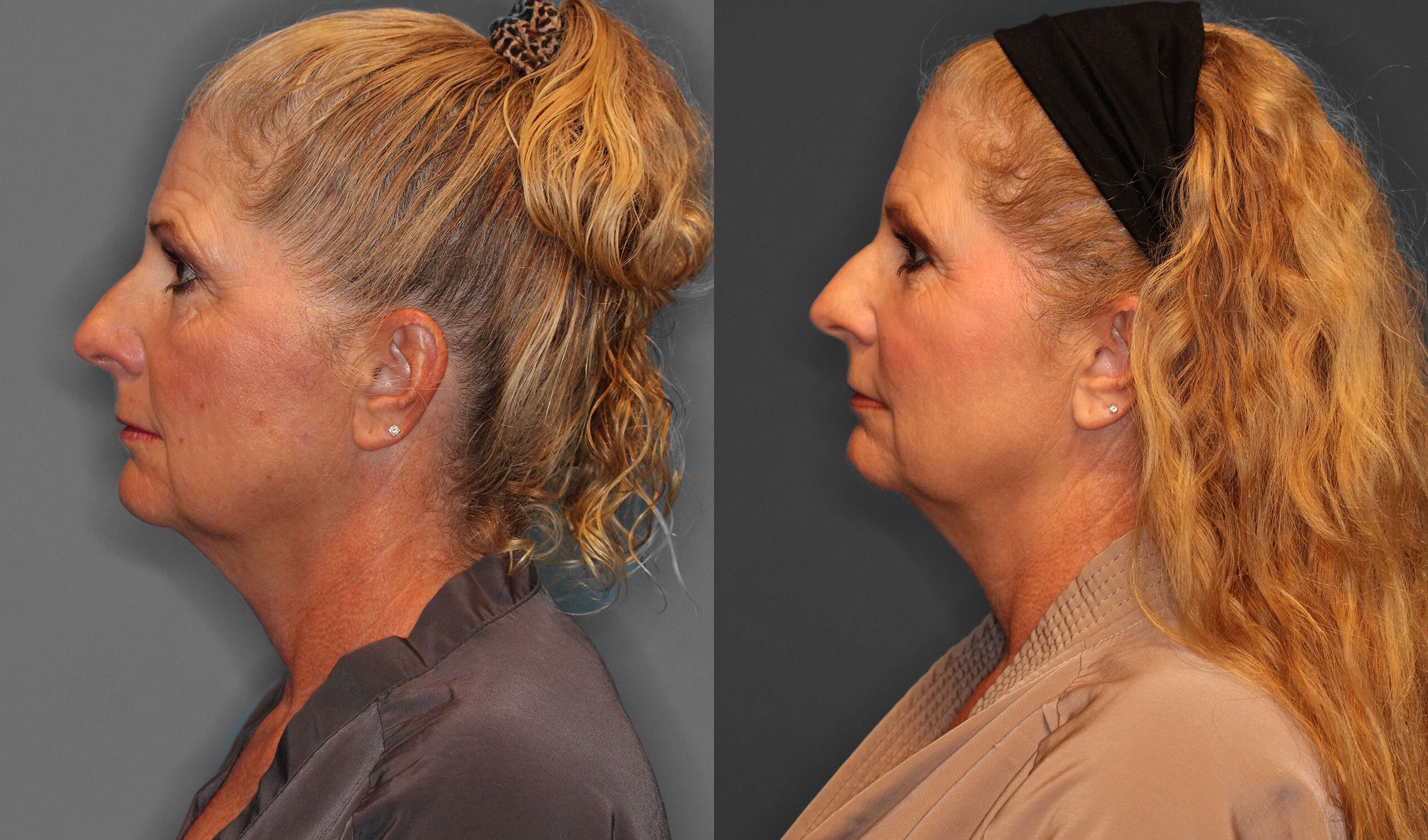 Facial Fat Grafting Before and After photo by Dr. Abigail Rodriguez in Houston, TX