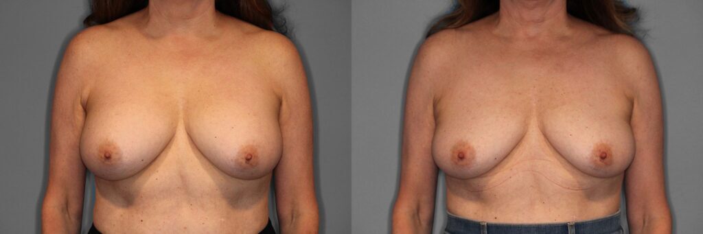 Implant Removal Before and After photo by Dr. Abigail Rodriguez in Houston, TX