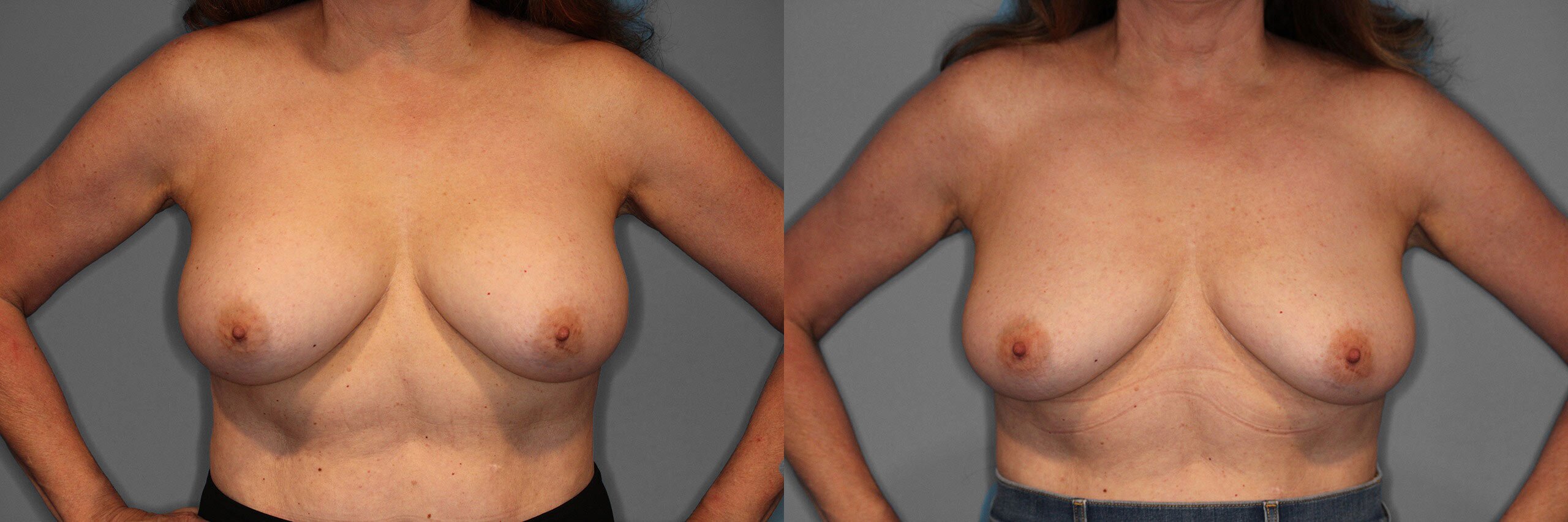 Implant Removal Before and After photo by Dr. Abigail Rodriguez in Houston, TX