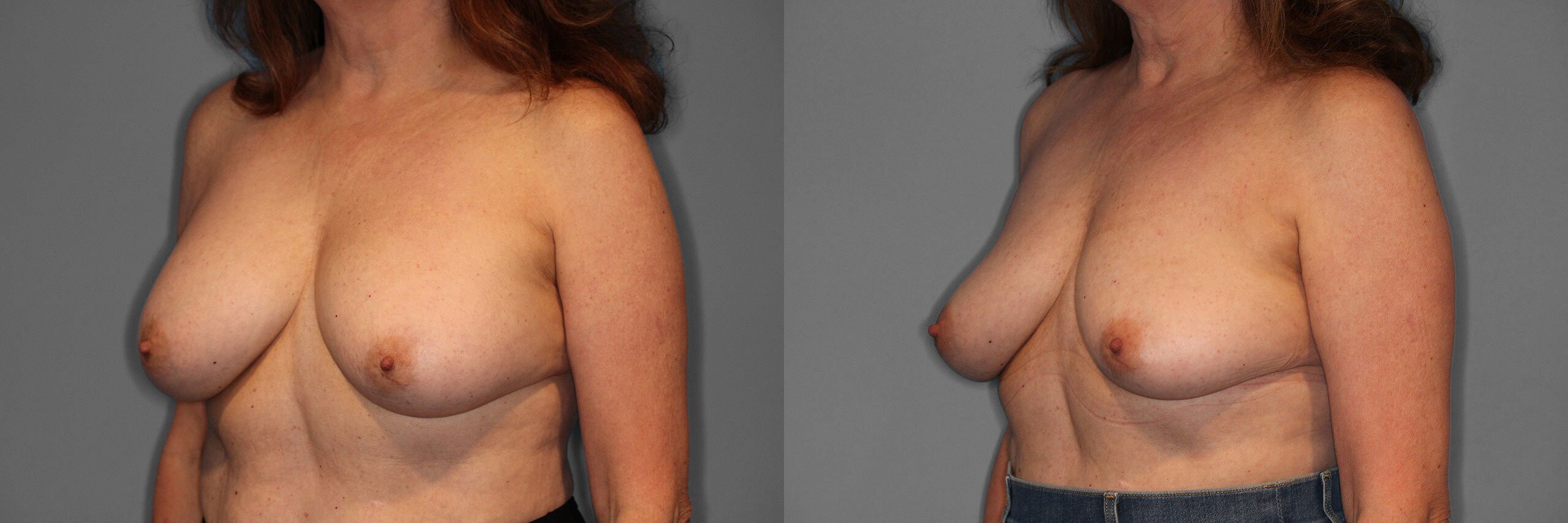 Implant Removal Before and After photo by Dr. Abigail Rodriguez in Houston, TX