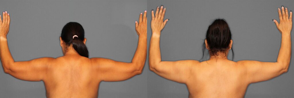 Liposuction Before and After photo by Dr. Abigail Rodriguez in Houston, TX