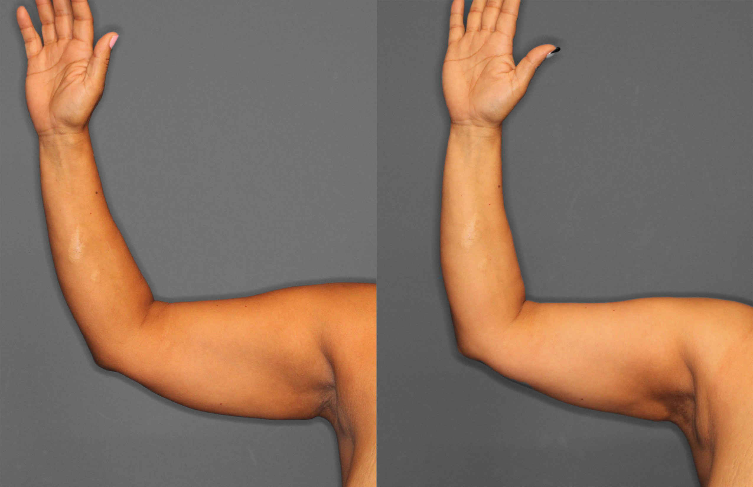 Liposuction Before and After photo by Dr. Abigail Rodriguez in Houston, TX