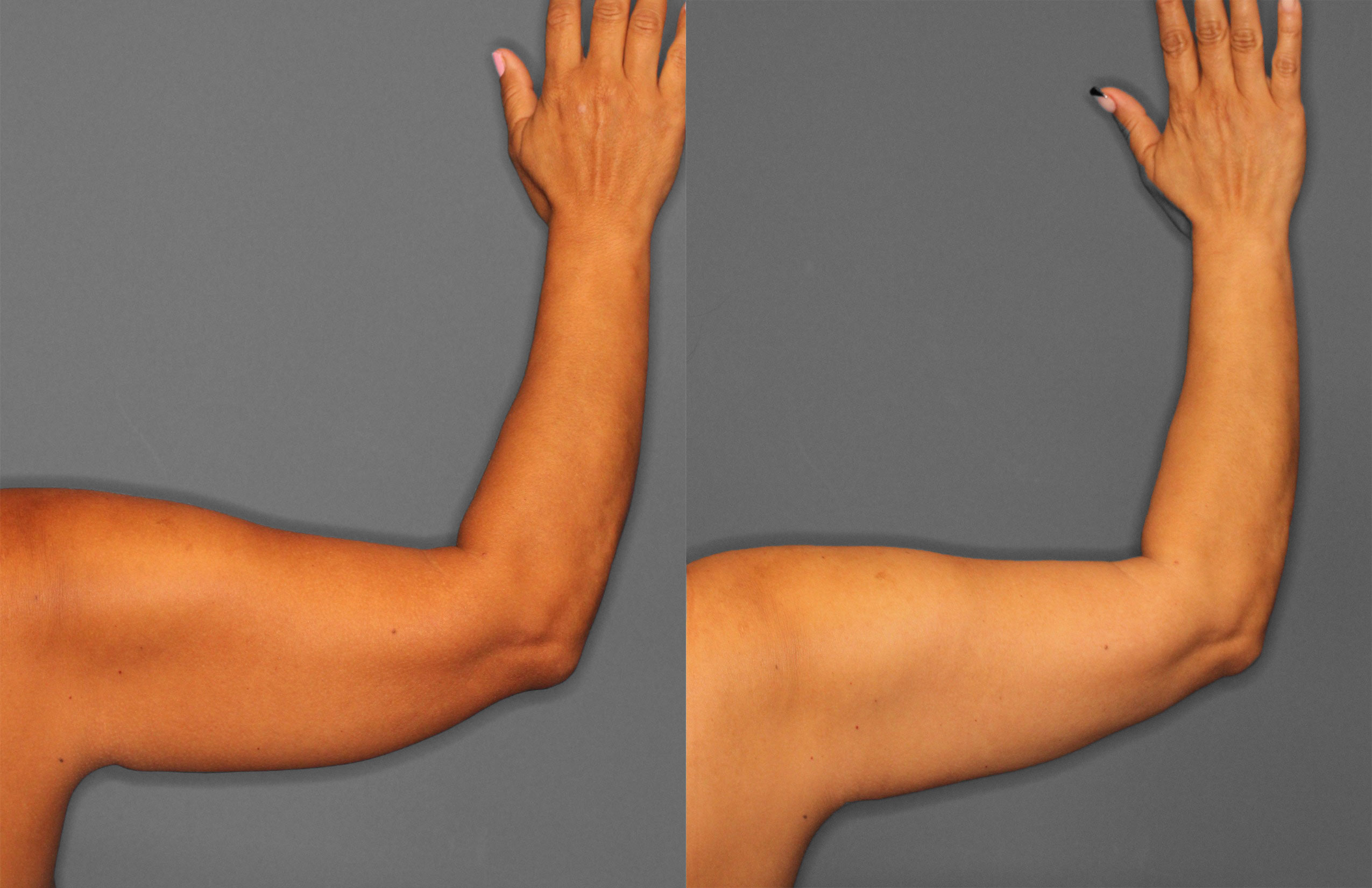 Liposuction Before and After photo by Dr. Abigail Rodriguez in Houston, TX