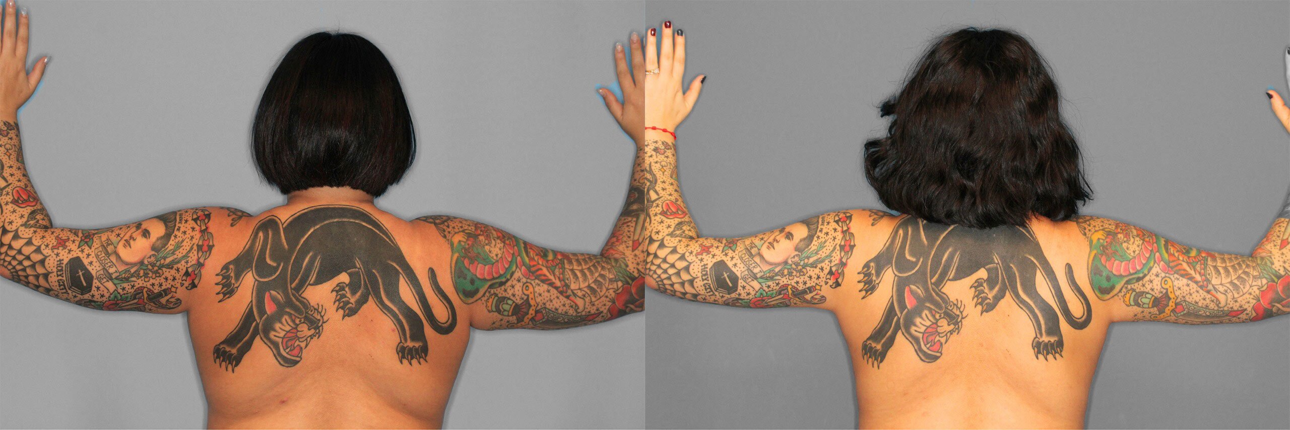 Liposuction Before and After photo by Dr. Abigail Rodriguez in Houston, TX