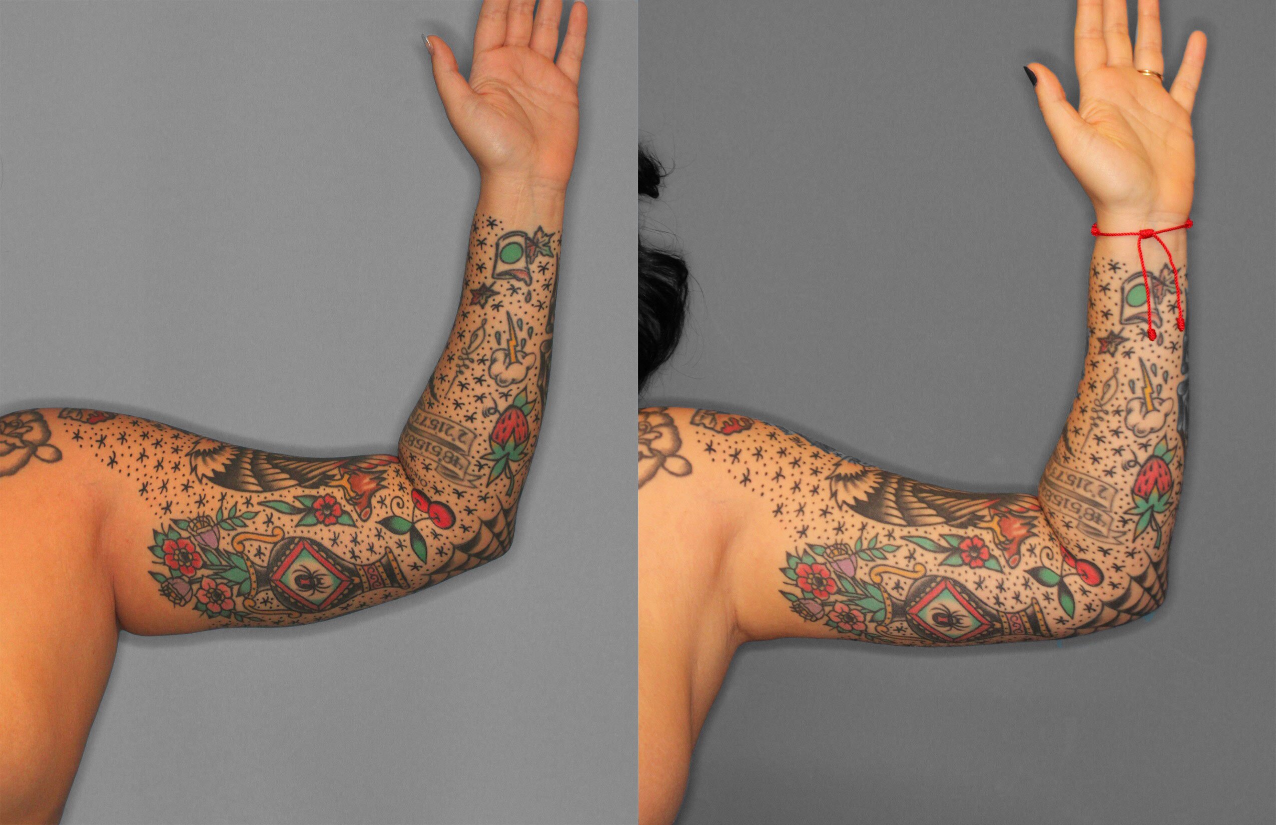 Liposuction Before and After photo by Dr. Abigail Rodriguez in Houston, TX