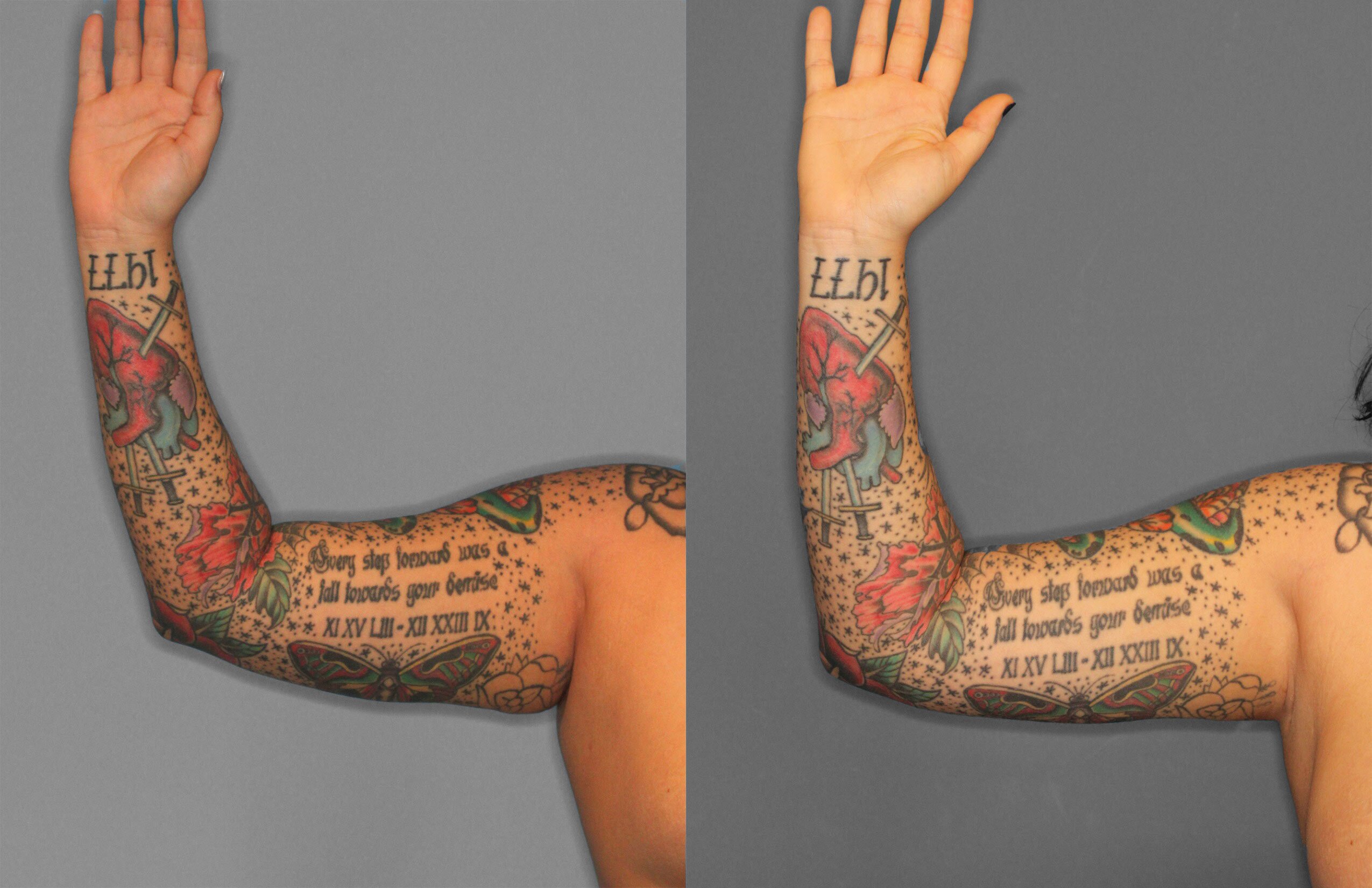 Liposuction Before and After photo by Dr. Abigail Rodriguez in Houston, TX