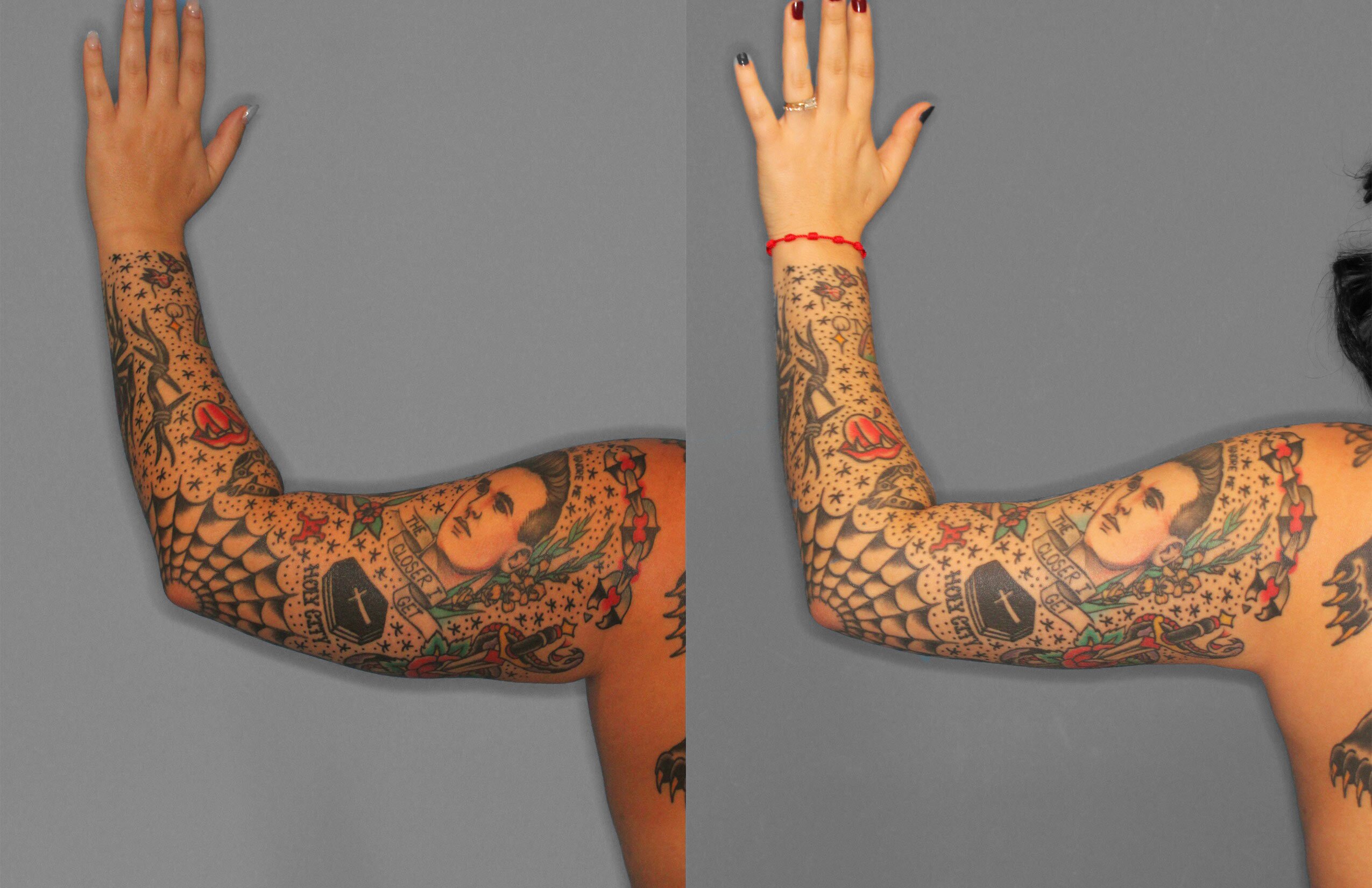 Liposuction Before and After photo by Dr. Abigail Rodriguez in Houston, TX