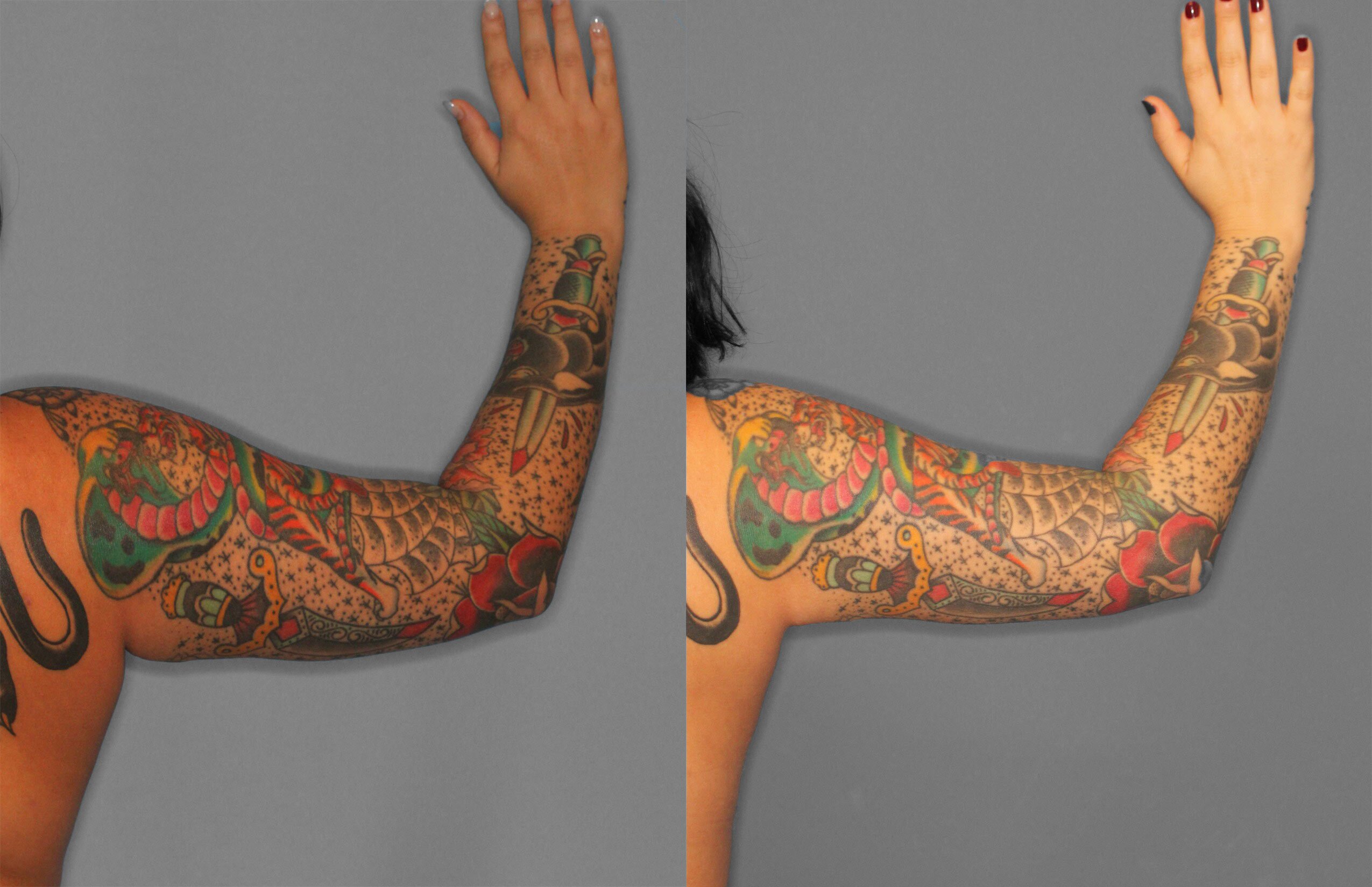 Liposuction Before and After photo by Dr. Abigail Rodriguez in Houston, TX