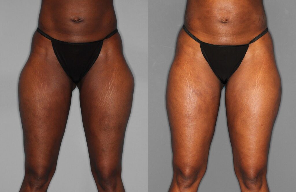 Liposuction Before and After photo by Dr. Abigail Rodriguez in Houston, TX