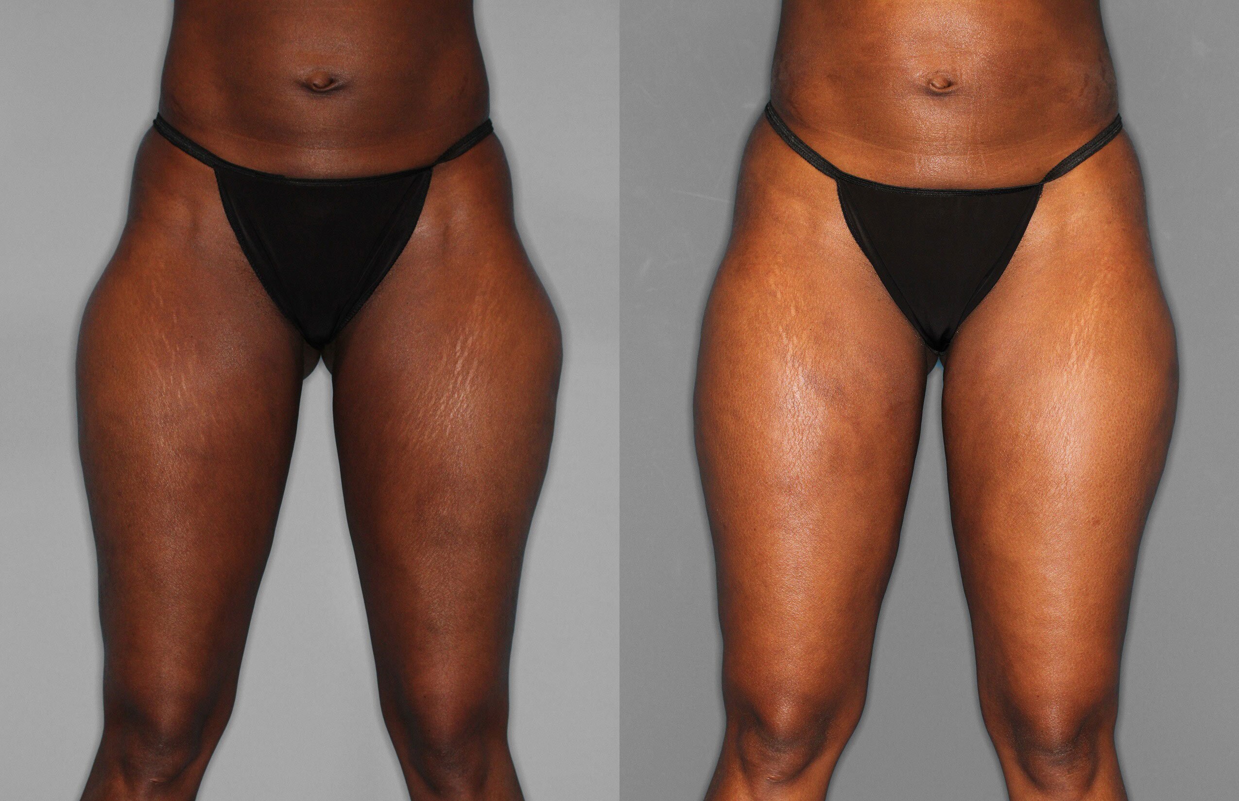 Liposuction Before and After photo by Dr. Abigail Rodriguez in Houston, TX