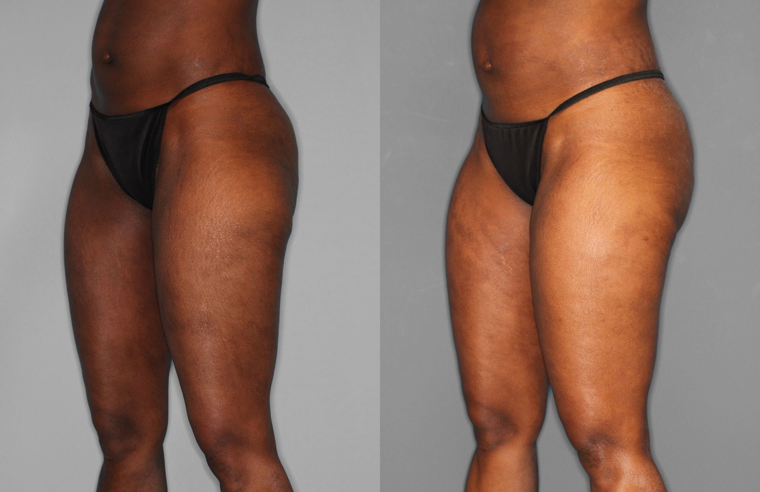 Liposuction Before and After photo by Dr. Abigail Rodriguez in Houston, TX