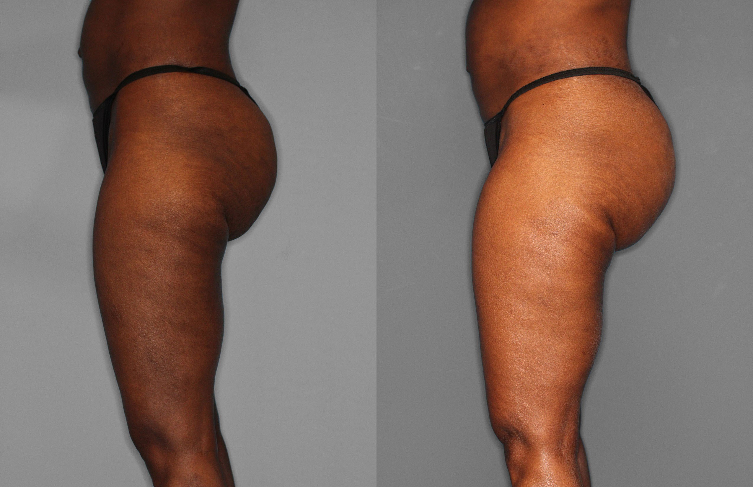 Liposuction Before and After photo by Dr. Abigail Rodriguez in Houston, TX
