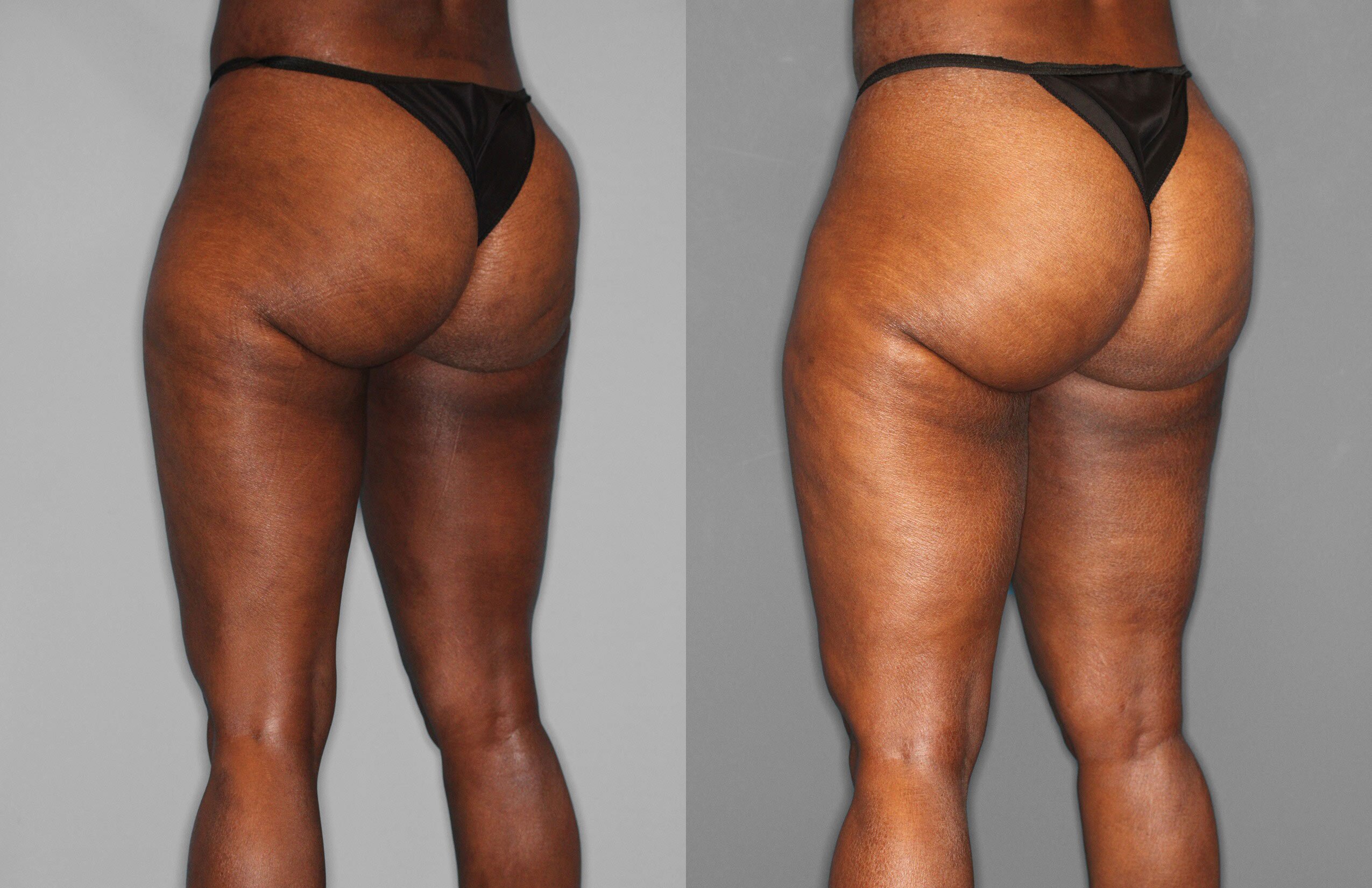 Liposuction Before and After photo by Dr. Abigail Rodriguez in Houston, TX