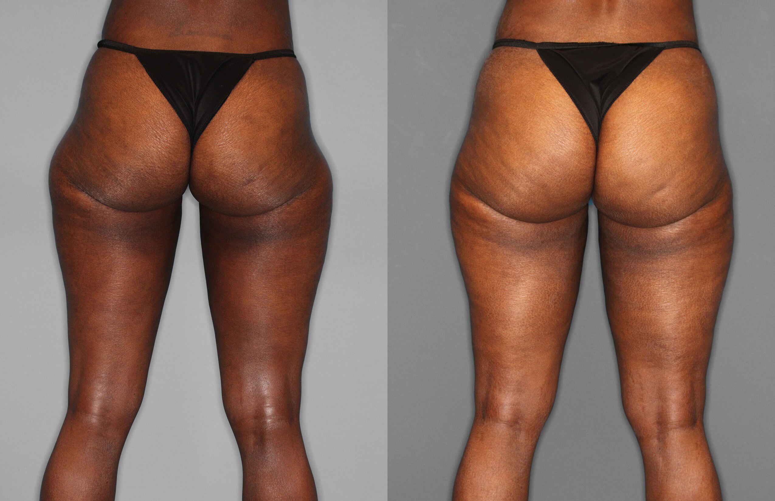 Liposuction Before and After photo by Dr. Abigail Rodriguez in Houston, TX