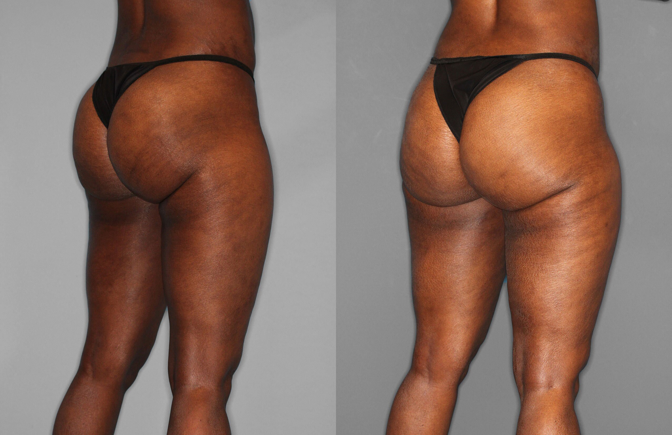 Liposuction Before and After photo by Dr. Abigail Rodriguez in Houston, TX