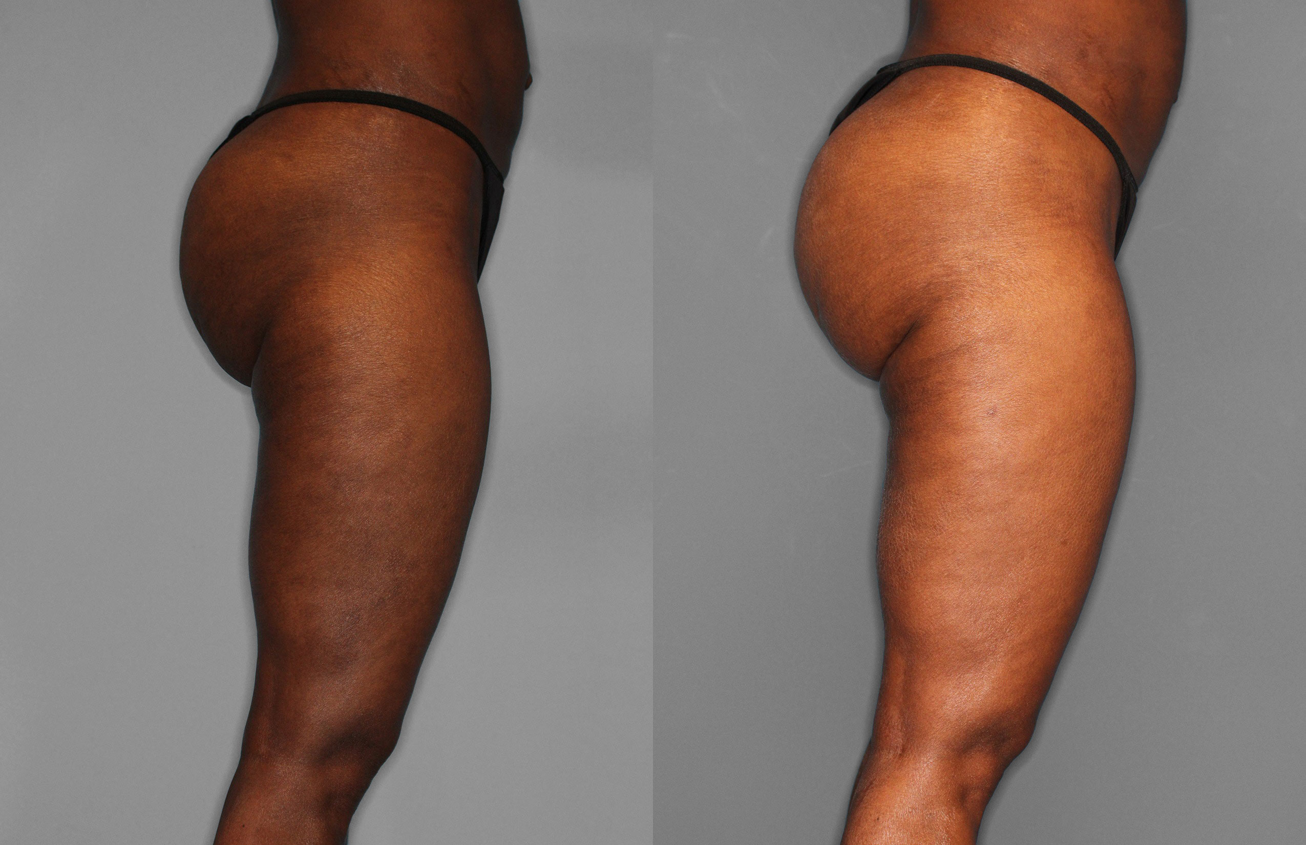 Liposuction Before and After photo by Dr. Abigail Rodriguez in Houston, TX