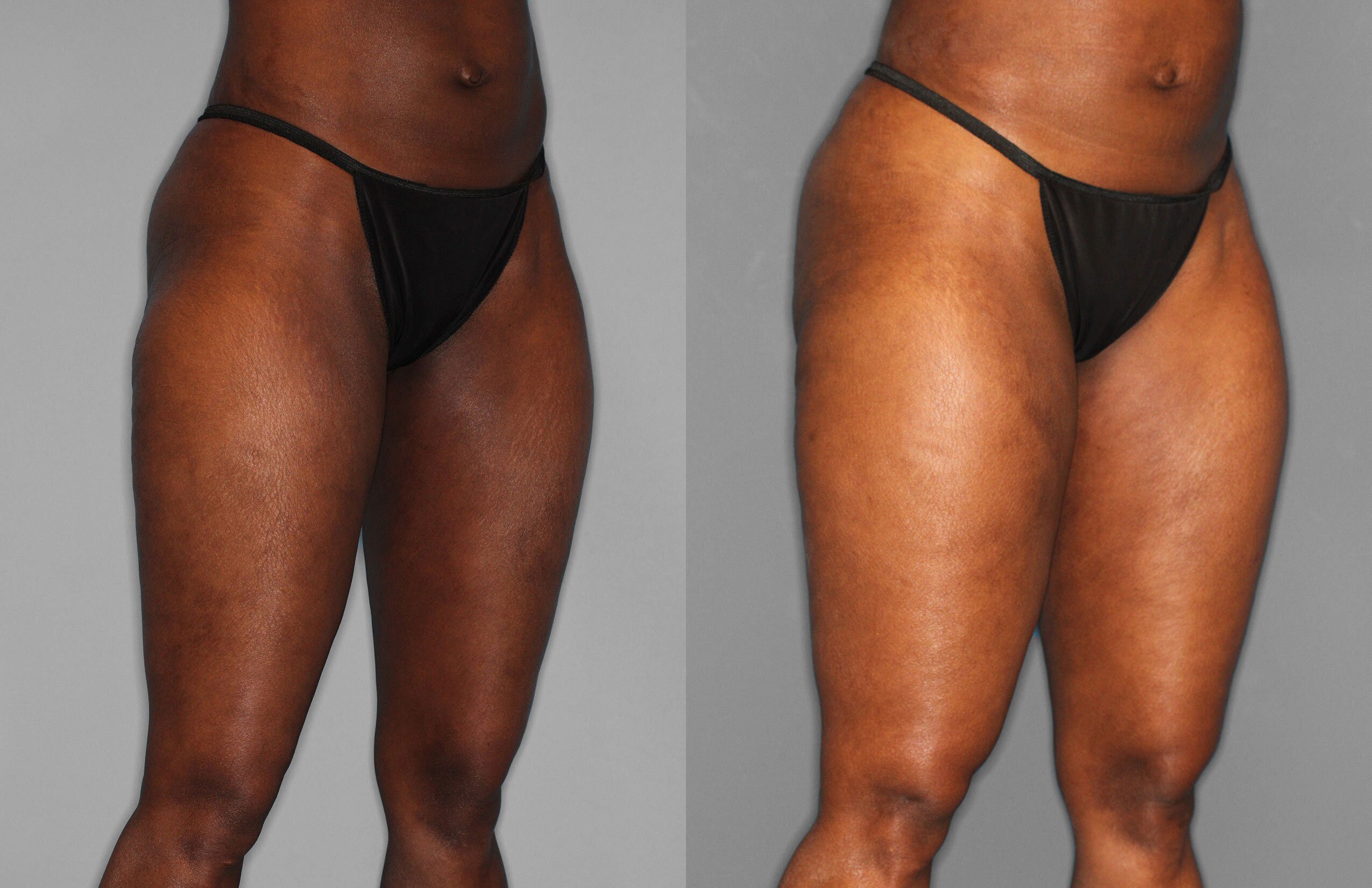 Liposuction Before and After photo by Dr. Abigail Rodriguez in Houston, TX