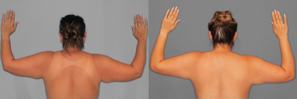 Liposuction and Renuvion Before and After photo by Dr. Abigail Rodriguez in Houston, TX