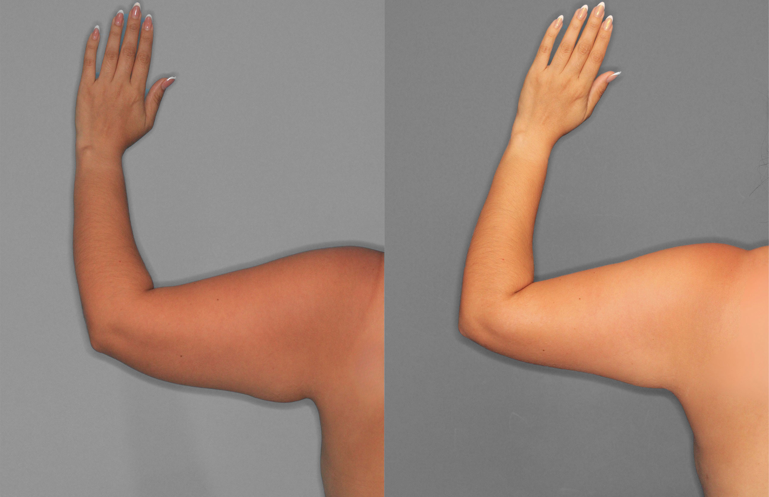 Liposuction and Renuvion Before and After photo by Dr. Abigail Rodriguez in Houston, TX
