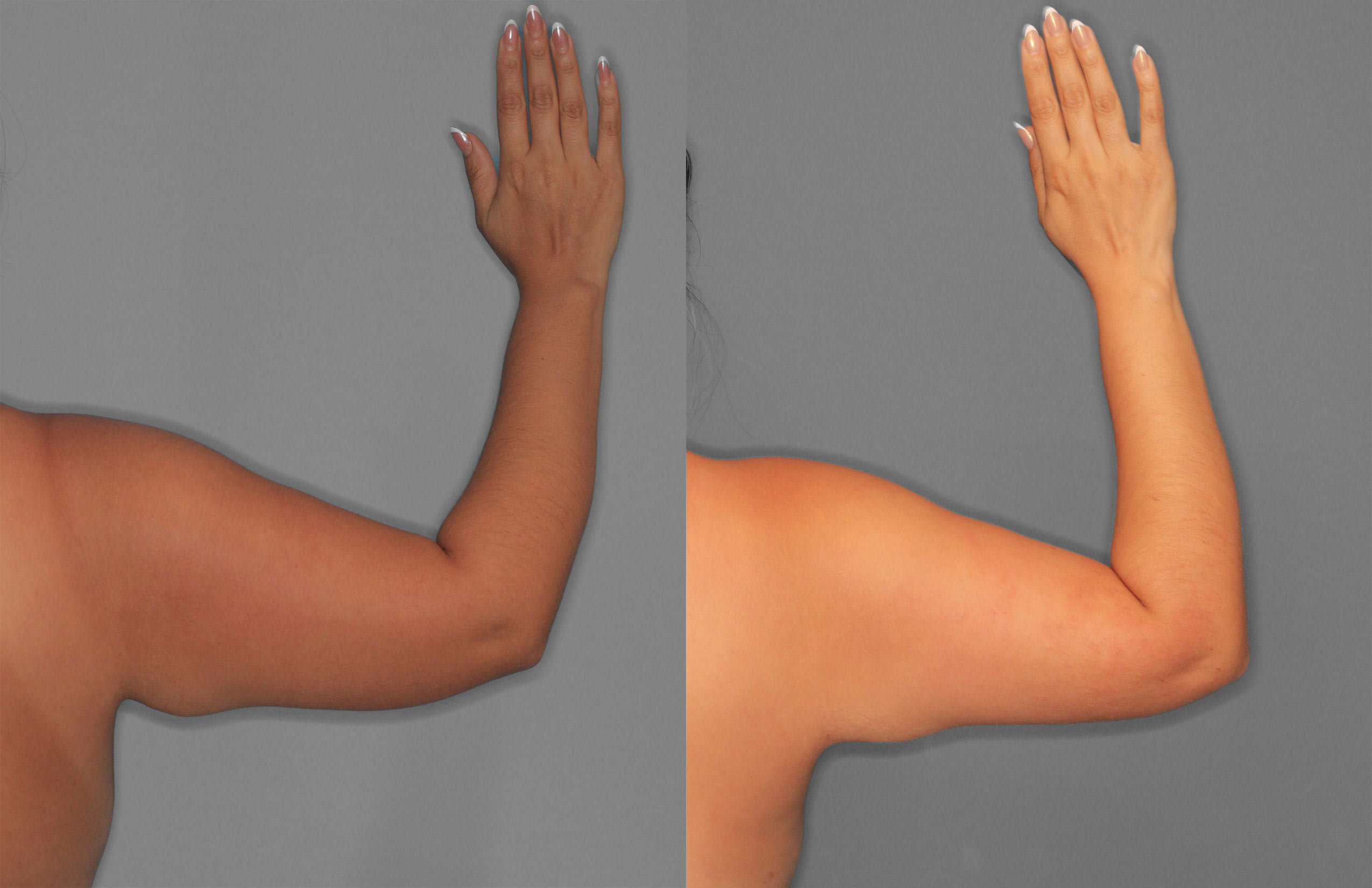 Liposuction and Renuvion Before and After photo by Dr. Abigail Rodriguez in Houston, TX