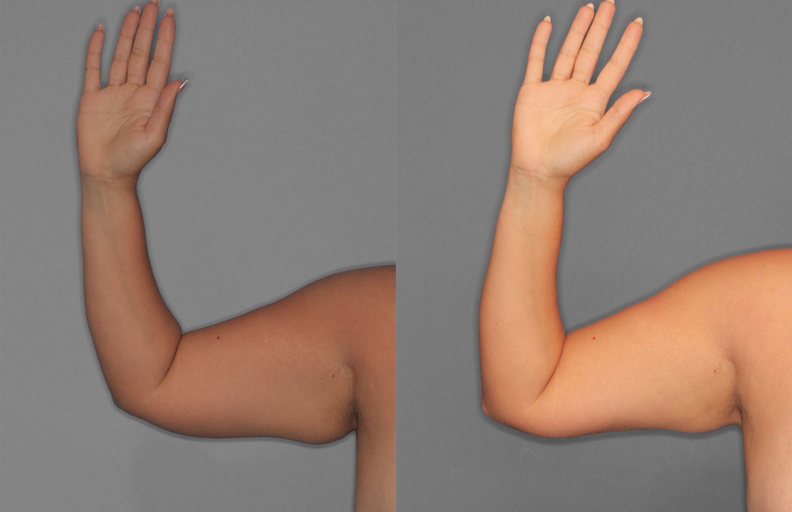 Liposuction and Renuvion Before and After photo by Dr. Abigail Rodriguez in Houston, TX