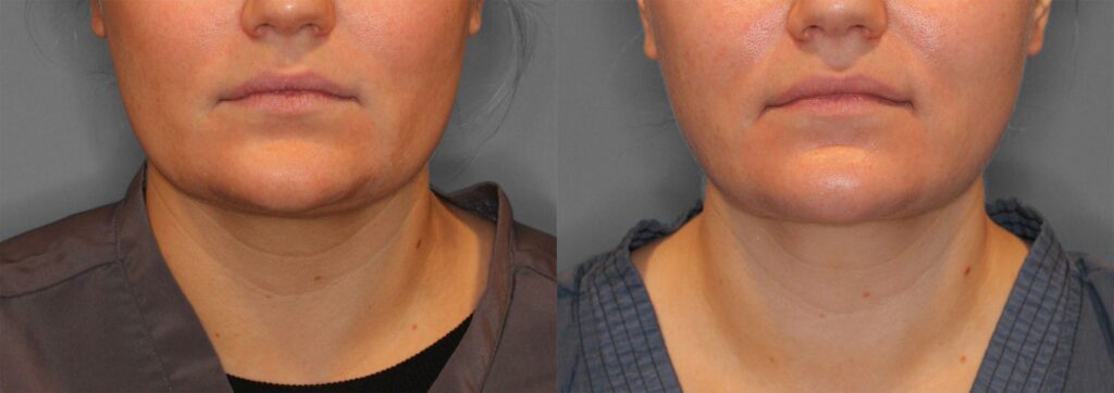 Neck Liposuction Before and After photo by Dr. Abigail Rodriguez in Houston, TX