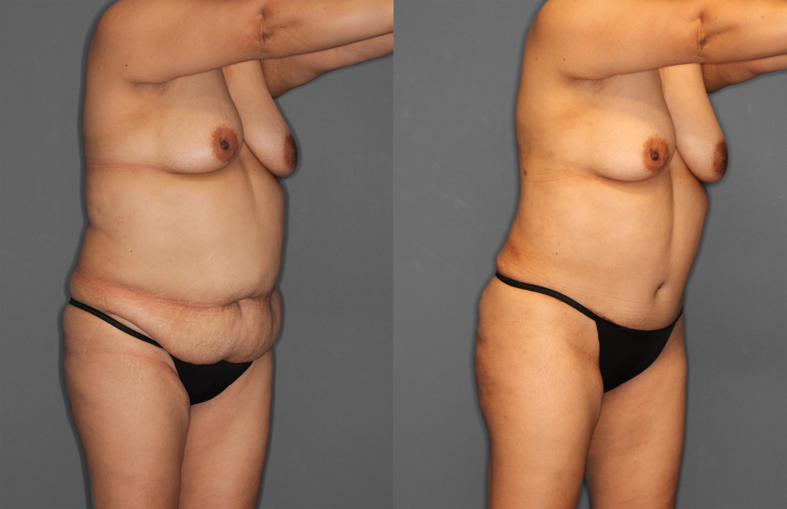 Tummy Tuck Before and After photo by Dr. Abigail Rodriguez in Houston, TX
