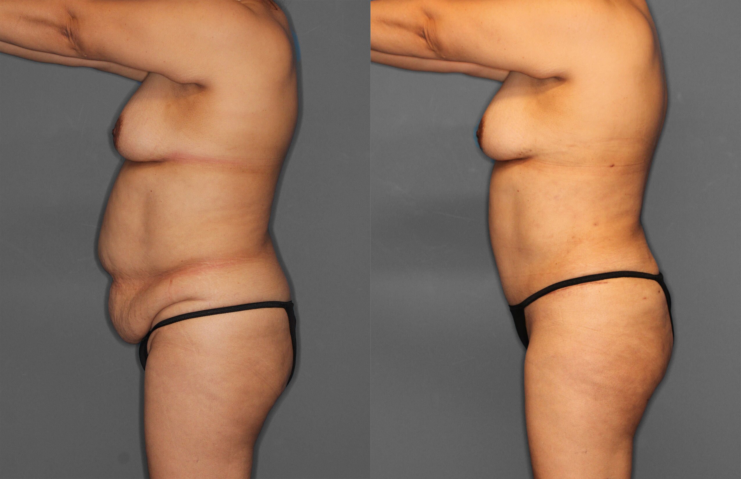 Tummy Tuck Before and After photo by Dr. Abigail Rodriguez in Houston, TX