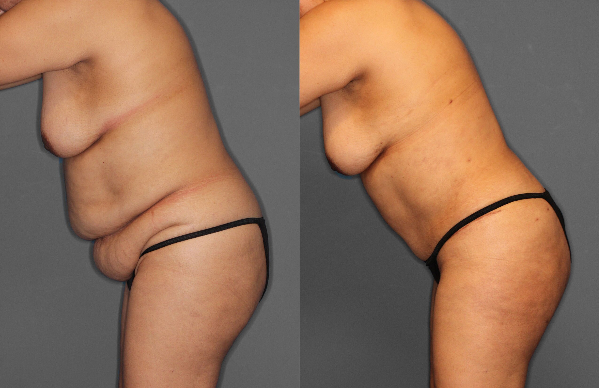 Tummy Tuck Before and After photo by Dr. Abigail Rodriguez in Houston, TX