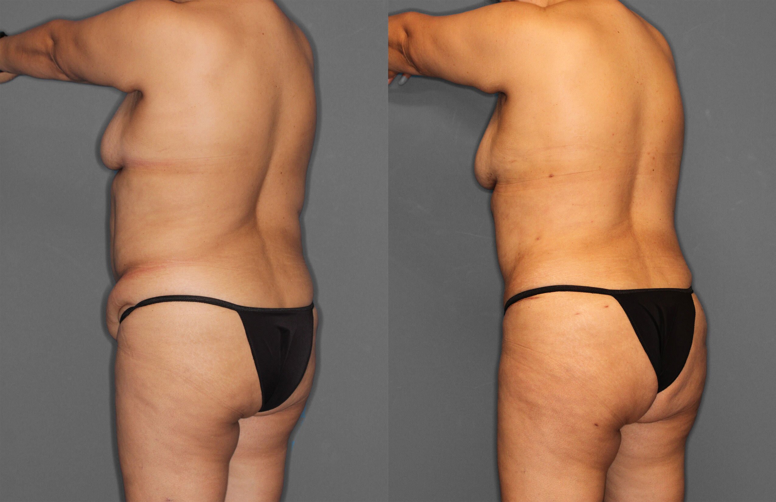 Tummy Tuck Before and After photo by Dr. Abigail Rodriguez in Houston, TX