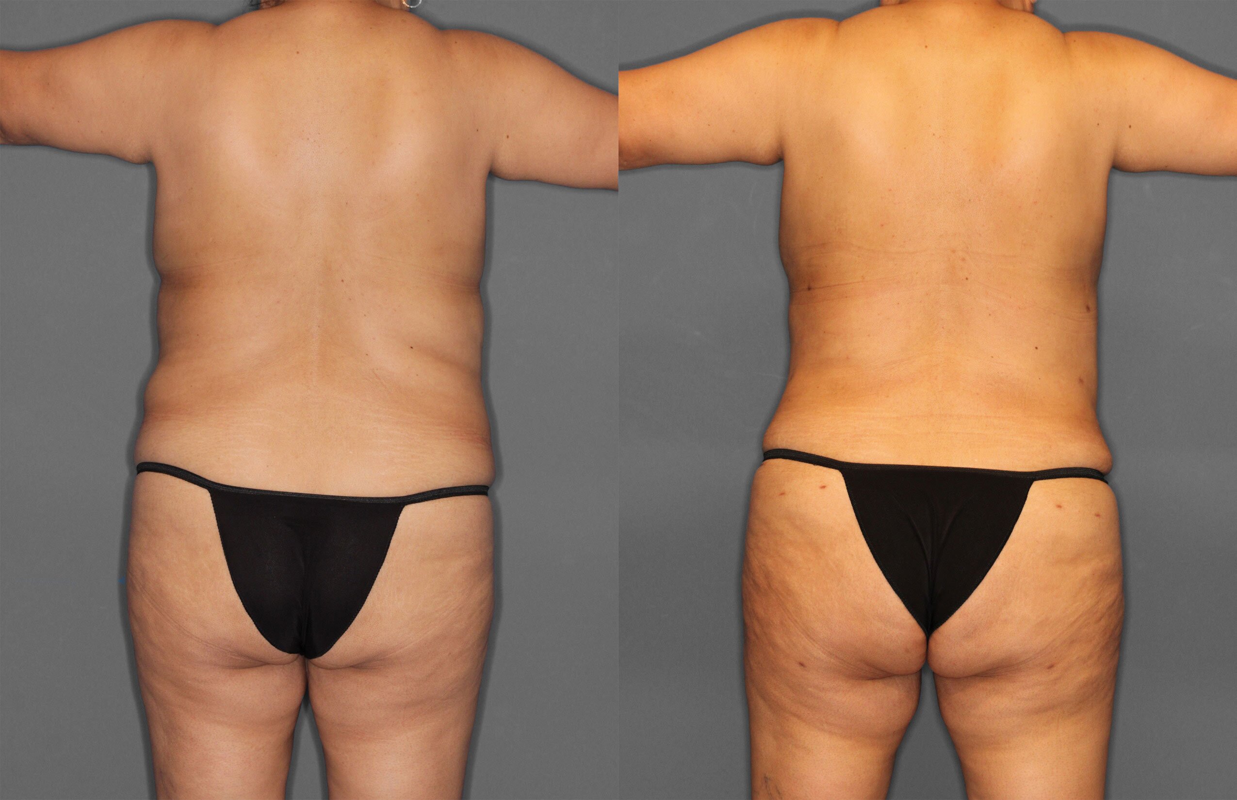 Tummy Tuck Before and After photo by Dr. Abigail Rodriguez in Houston, TX